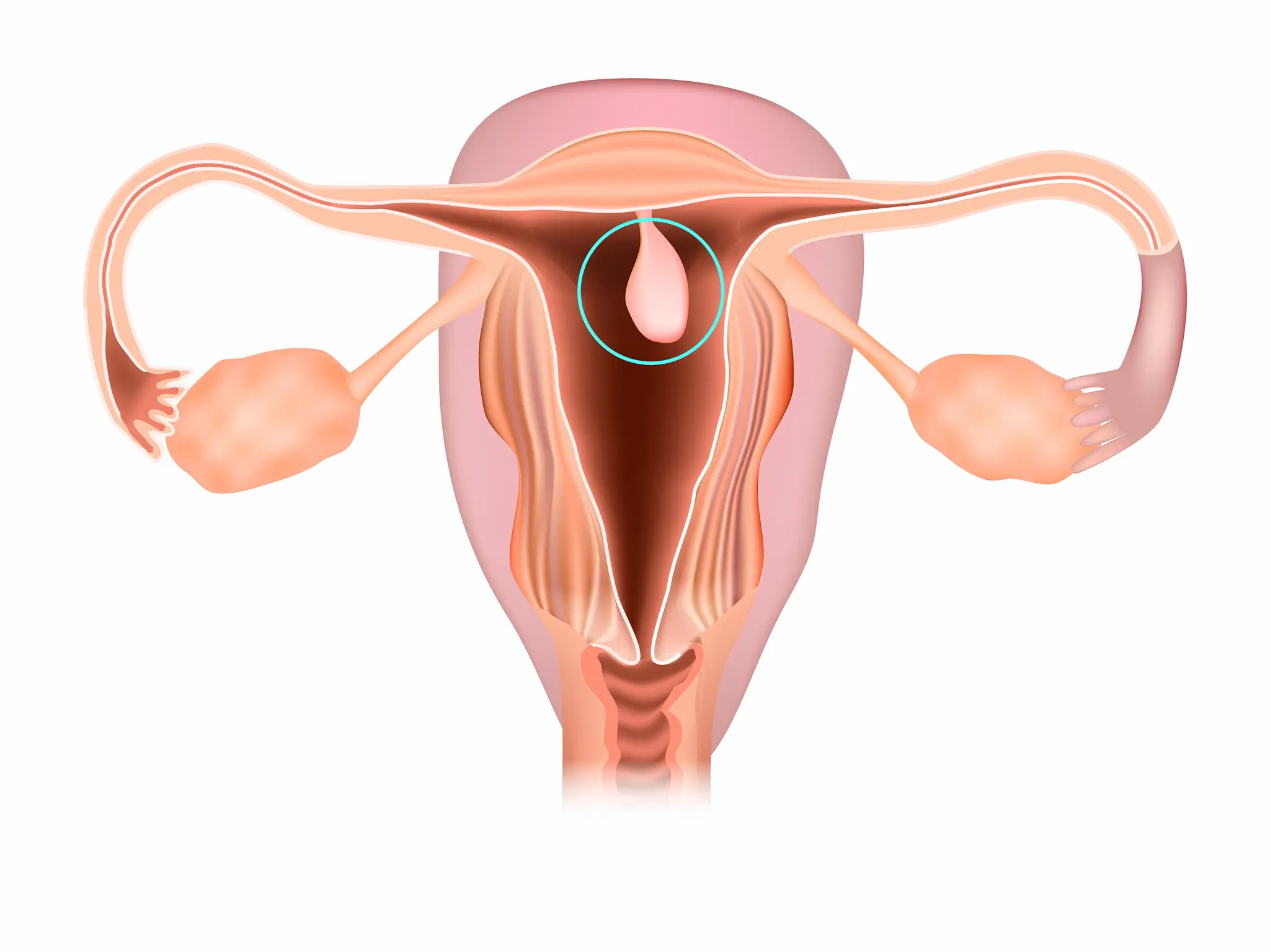 Endometrial Polip